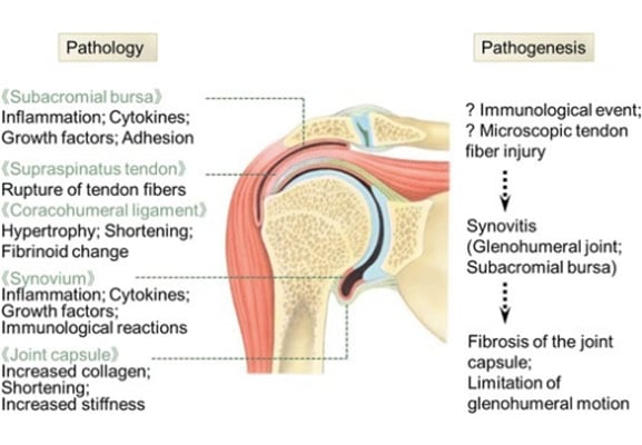 Diabetic Shoulder Capsular Pattern
